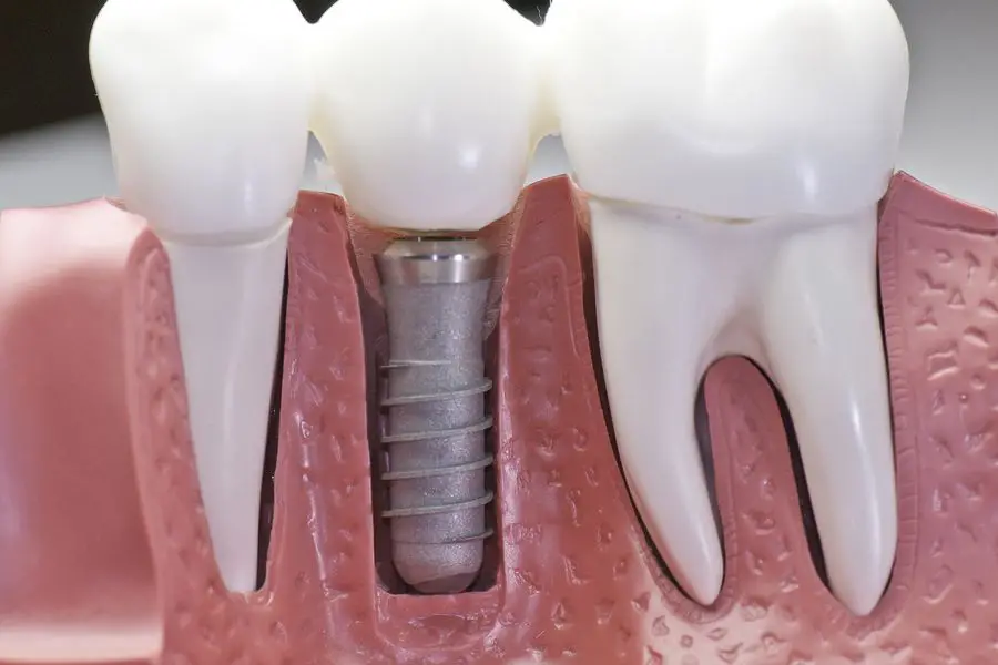 Are Dental Implants an Ideal Restorative Treatment