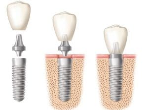 dental implants Santa Rosa