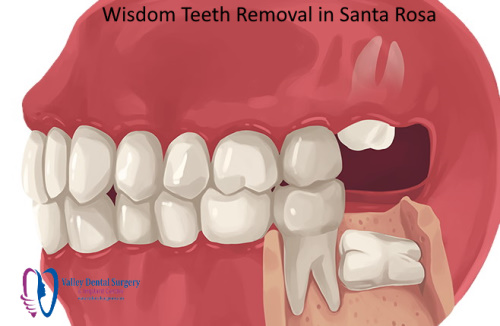 Wisdom Teeth Extraction in Santa Rosa
