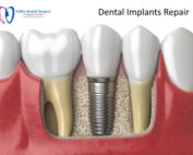 Repairing a Dental Implant