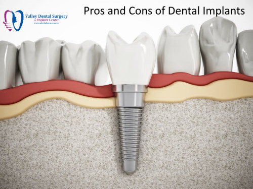 Benefits and Risks of Dental Implants
