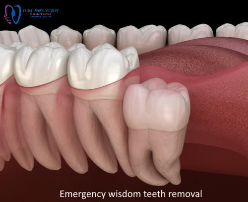 Emergency wisdom teeth removal in Santa Rosa